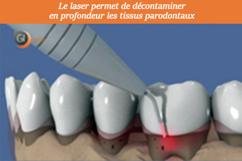 laser dentiste